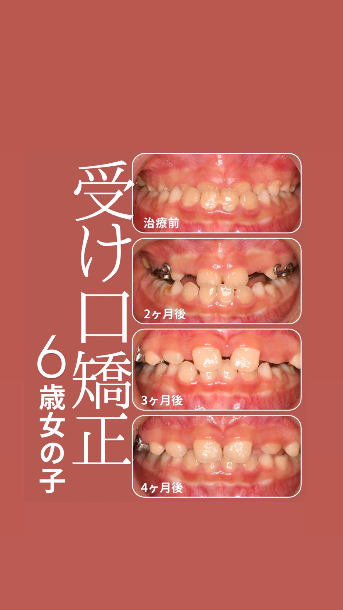 小児矯正】6歳から始めた受け口（反対咬合）の症例紹介（経過観察中