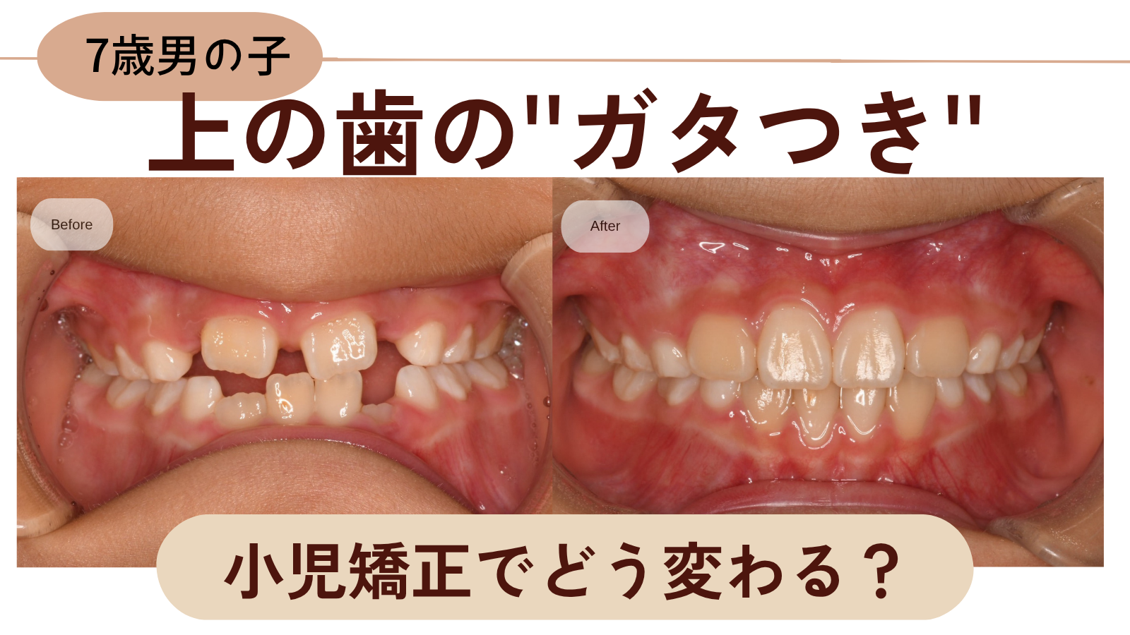 7歳で上の歯がガタガタ…このままで大丈夫？成長期だからこそできる矯正