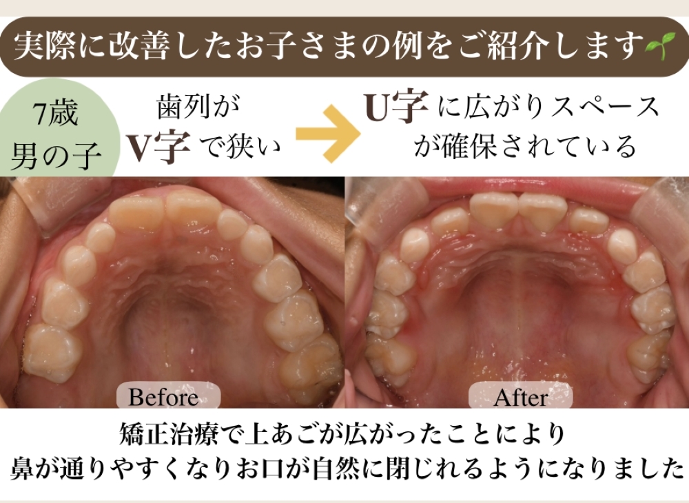 image_tooltip 改善したお子様の症例