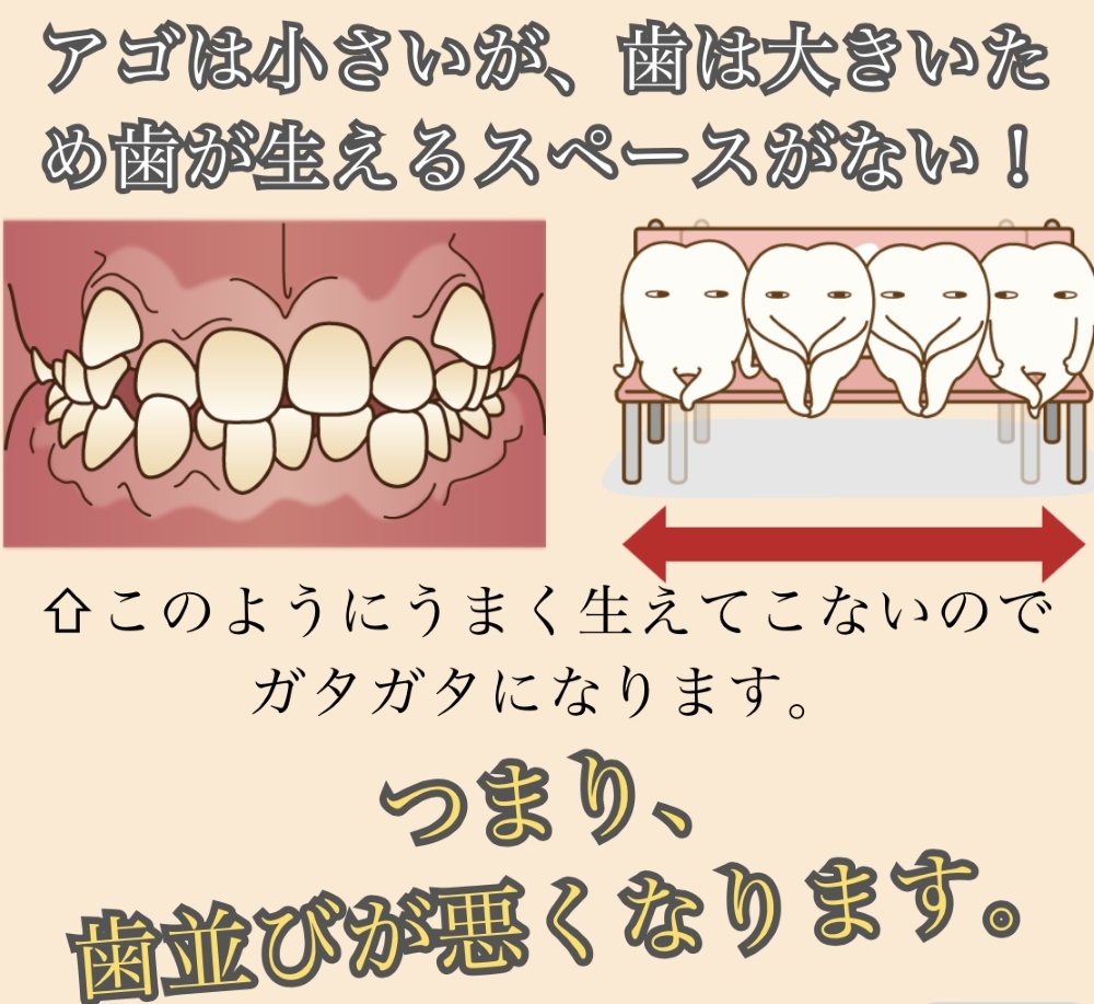 image_tooltip 顎は小さいが歯は大きいため歯が生えるスペースがない