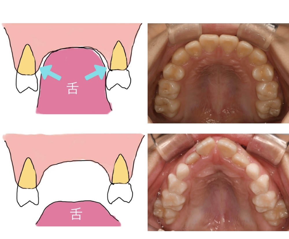image_tooltip 口呼吸・低位舌が顎の成長を妨げる
